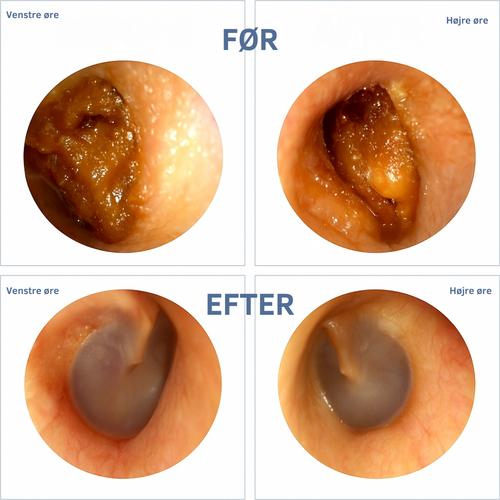 WaxClean™ – Smart ørerens med avanceret teknologi