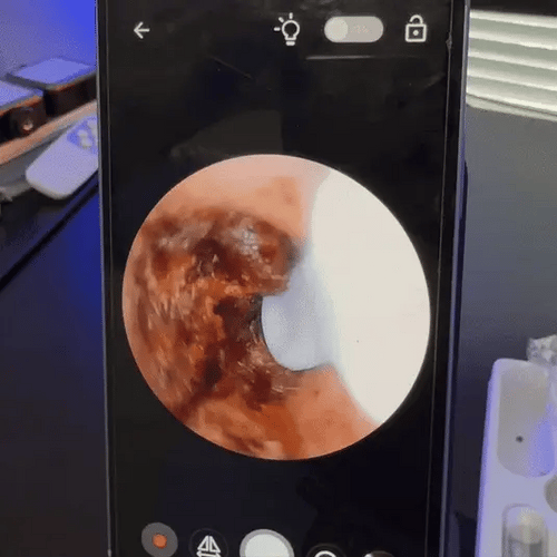 WaxClean™ – Smart ørerens med avanceret teknologi